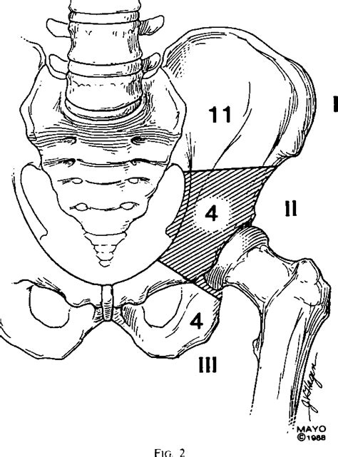 Figure 1 From Treatment Of Giant Cell Tumor Of The Pelvis Semantic Scholar