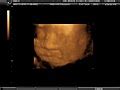 categoryultrasound images  pregnancy surface rendered wikimedia