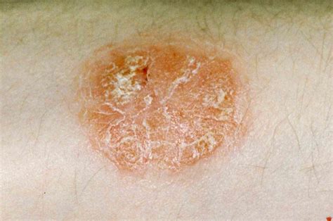 types  psoriasis       affected    expect