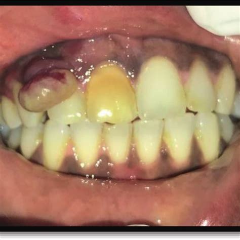 Criteria For Diagnosis Of Periodontitis According To Its Severity Level