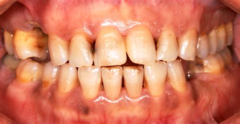 Types of Gum Disease | Orlando Periodontist