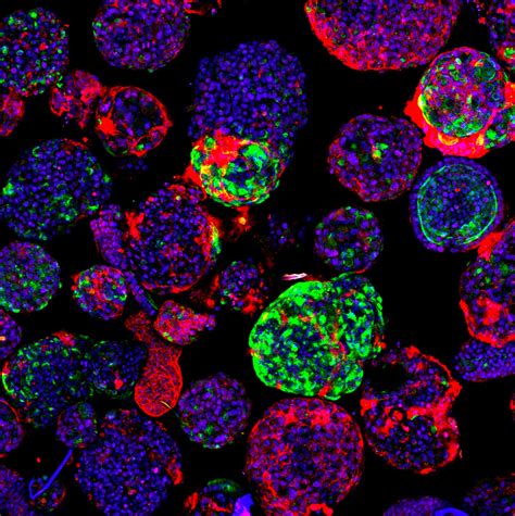 Organoids And Crispr Cas9 Provide Insights Into Rare Liver Cancer