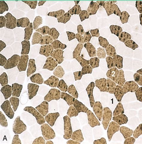 Msk Exam Pathology Diseases Of Skeletal Muscle Flashcards Quizlet