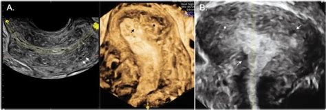 Association Of 2d And 3d Transvaginal Ultrasound Findings With