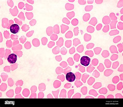 Leucemia Linfoc Tica Cr Nica Micrograf A Ligera Fotograf A De Stock