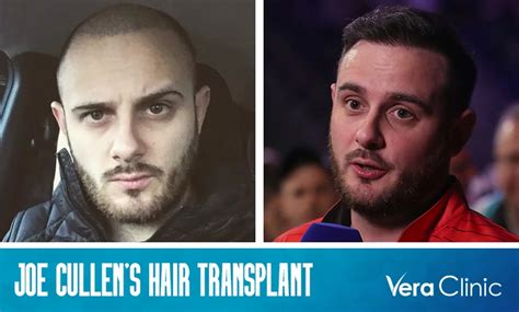 Darts Star Joe Cullen Hair Transplant: Enhancing His "Rock Star" Image