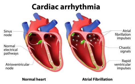 Arrhythmia Home Remedy Treatment - Home Remedy and Natural Cures