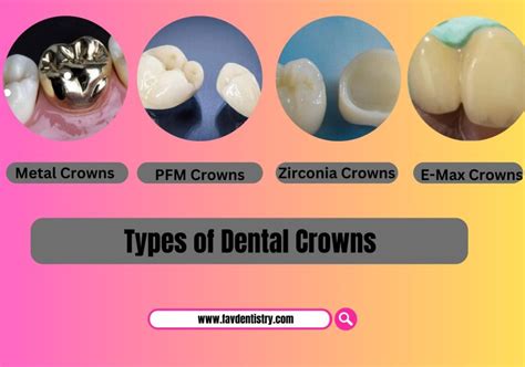 Types of Dental Crowns - favourite dentistry