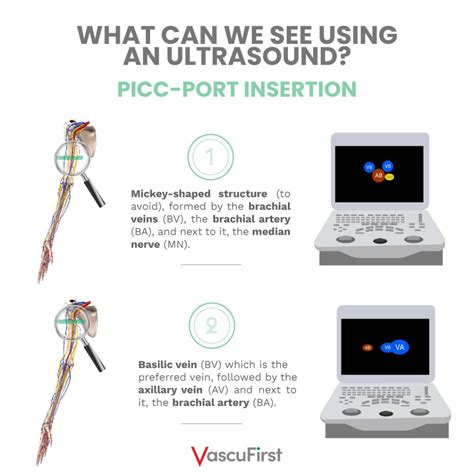 Tips For Proper Picc Port Placement Vascufirst