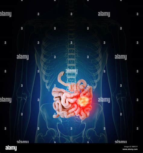 Ilustración De Cáncer De Intestino Fotografía De Stock Alamy