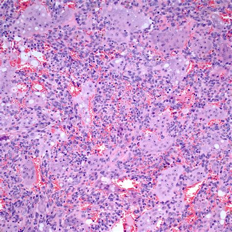 Pathology Outlines - Giant cell tumor of bone