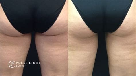 Coolsculpting Fat Freezing Treatments In Central And West London