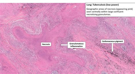 Tuberculosis Lungs Histology