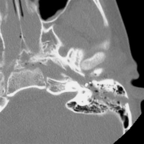 Temporal bone fracture - by Alexander Baxter - RadNotes