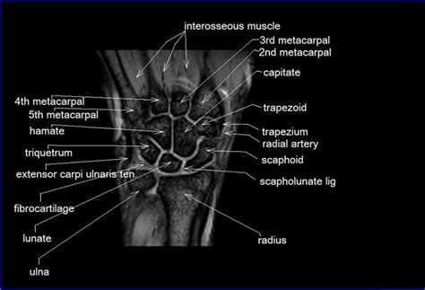 Mri Wrist Coronal Anatomy Wrist Tendon And Ligaments Anatomy Cross