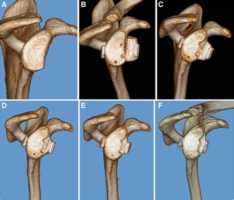 All Arthroscopic Glenoid Bone Augmentation Using Iliac Crest Autograft Procedure For Recurrent