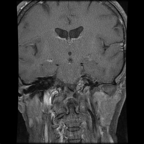 Meningiomas Cavernous Sinus And Temporal Image Radiopaedia Org