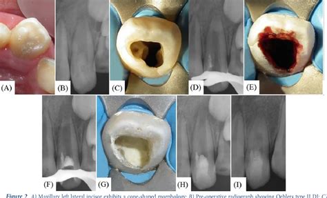 Figure 2 From Non Surgical Endodontic Management Of Type II Dens