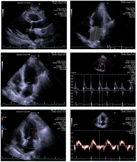 Two Dimensional Echocardiogram Showing Left Ventricular Remodelling And