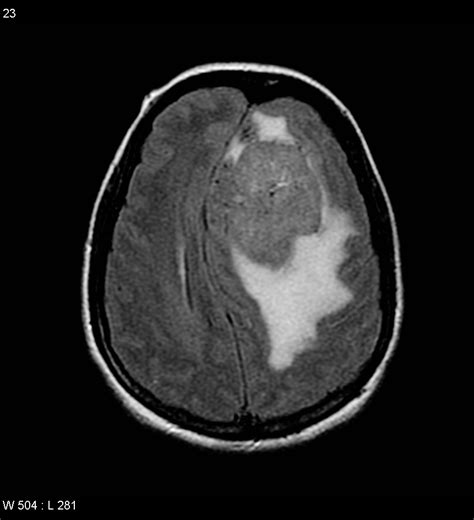 Meningioma Image Radiopaedia Org