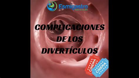 Complicaciones De Los Divertículos Youtube