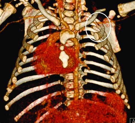 Preoperative Ct Chest Angiography A 3d Reconstruction Of Major Chest Images