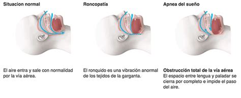 Apnea del sueño - Clínica Birbe - Cirugía ortognática en Barcelona