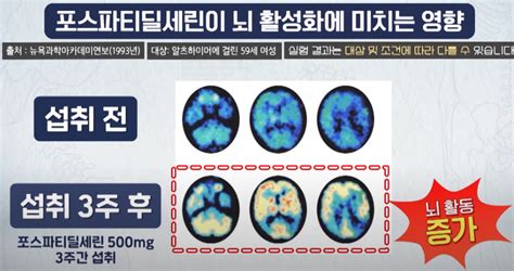 포스파티딜 세린의 효능과 부작용