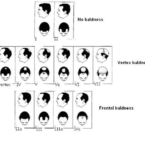 Hamilton Norwood Scale Of Baldness Download Scientific Diagram