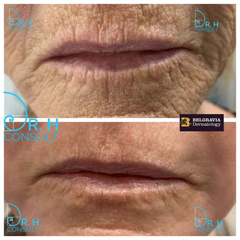 Fully Ablative Co2 Laser Resurfacing Treatment Dr H Consult