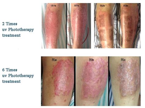 Uv Light Treatment For Psoriasis Reviews Shelly Lighting