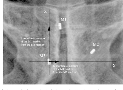 Figure From Hormone Therapy Modify The Position Of The Gold Markers