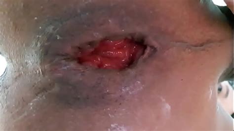 Anal Rosebud Free Mobile Porn Videos IPornTV