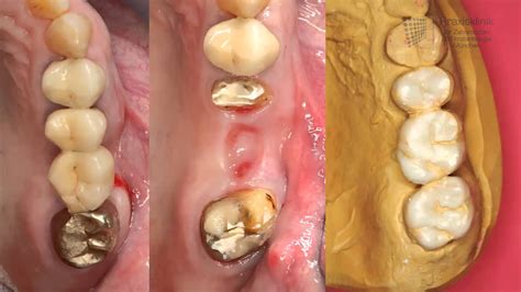 Kronen und Brücken Ästhetischer Zahnersatz für beschädigte Zähne Dr