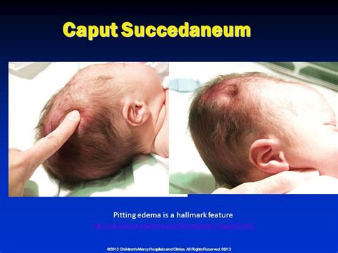 Cephalohematoma Versus Caput Succedaneum