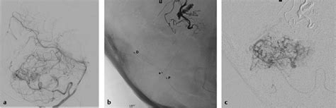 Endovascular Treatment Of Arteriovenous Malformations Of The Supratentorial Compartment Neupsy Key