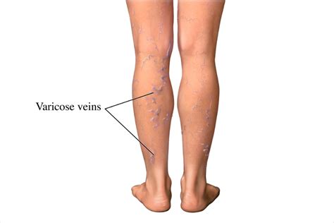 Understanding Varicose Veins Symptoms Treatment Options And The