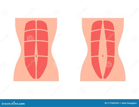 Normal Tone Muscle Abdomen And Diastasis Recti Weak And Divergence