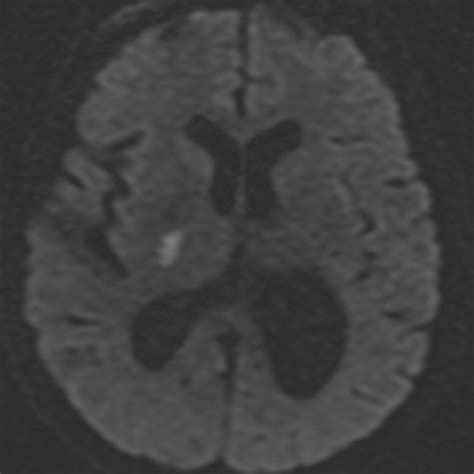 Imaging Of Stroke Part Perfusion Ct Overview Of Imaging Technique