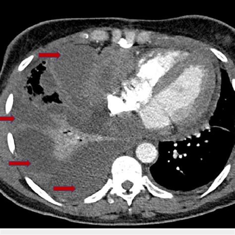 Ct Of Chest Showing Multiple Large Multi Loculated Pleural Effusions