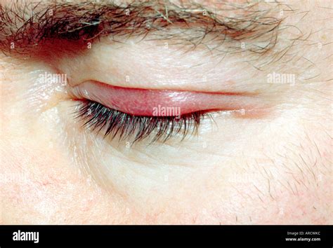 Blepharitis Hi Res Stock Photography And Images Alamy