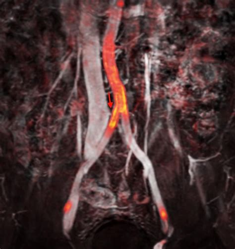 Pic Of The Day May Thurner Syndrome This 50 Years Old Presented With