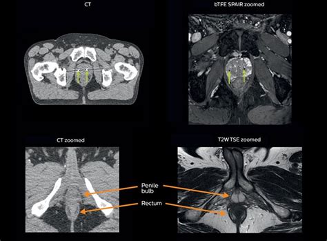 Including Mri In Radiation Therapy Planning Fieldstrength Mri