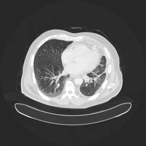 Lung Cancer Instance Segmentation Dataset By Khulna University Of