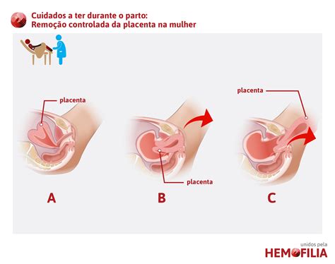 Cuidados P S Parto Unidos Pela Hemofilia