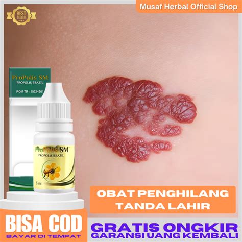 Jual Obat Penghilang Tanda Lahir Tanda Lahir Coklat Hitam Propolis SM