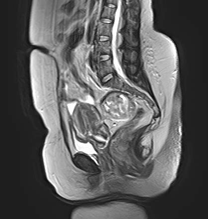 Pelvic Schwannoma Image Radiopaedia Org