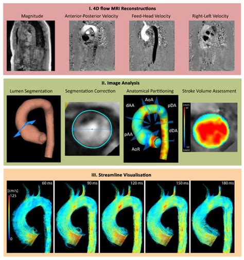 Applied Sciences Free Full Text D Flow Mri In Ascending Aortic