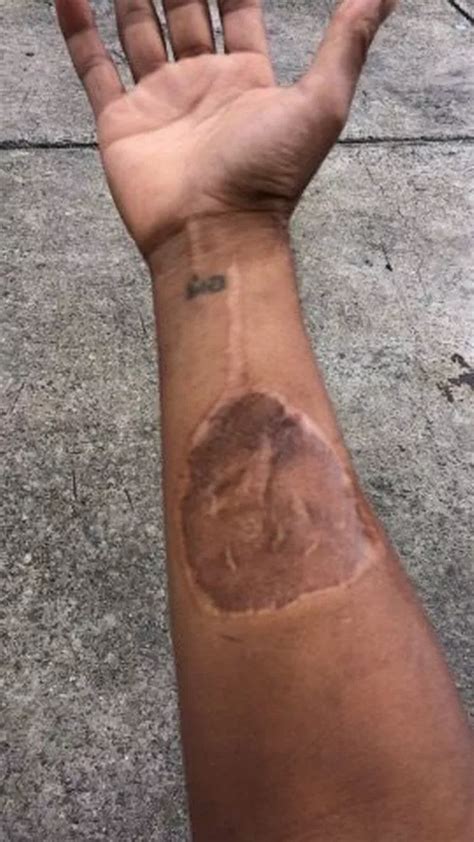 King Cobra Snake Bite