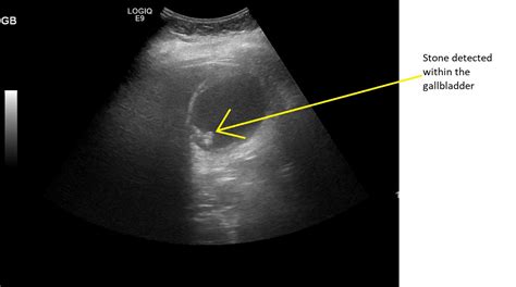 Gallbladder Stones Ultrasound